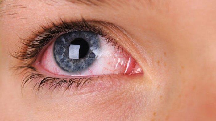 Gangguan Mata Yang Menyebabkan Penglihatan Ganda