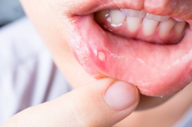 Penyebab dan Cara Mengatasi Benjolan Nanah Di Gigi